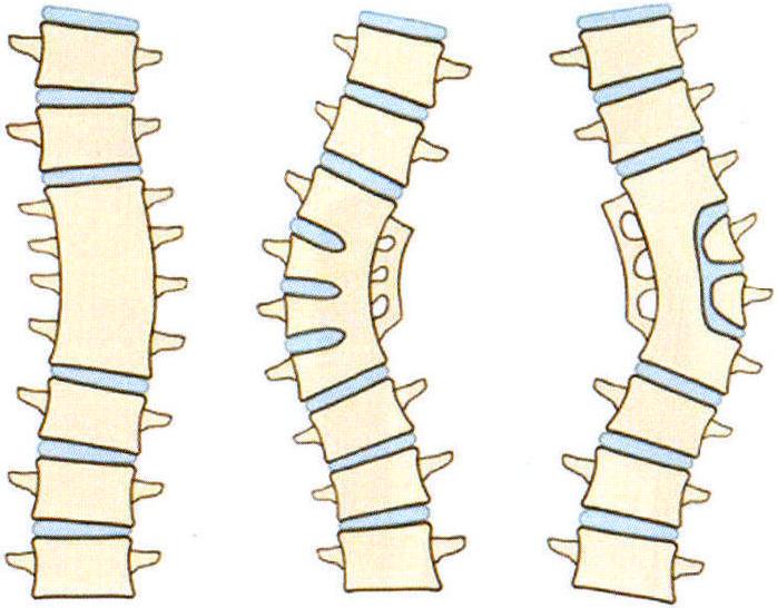 第一节 先天性脊柱侧凸的分类